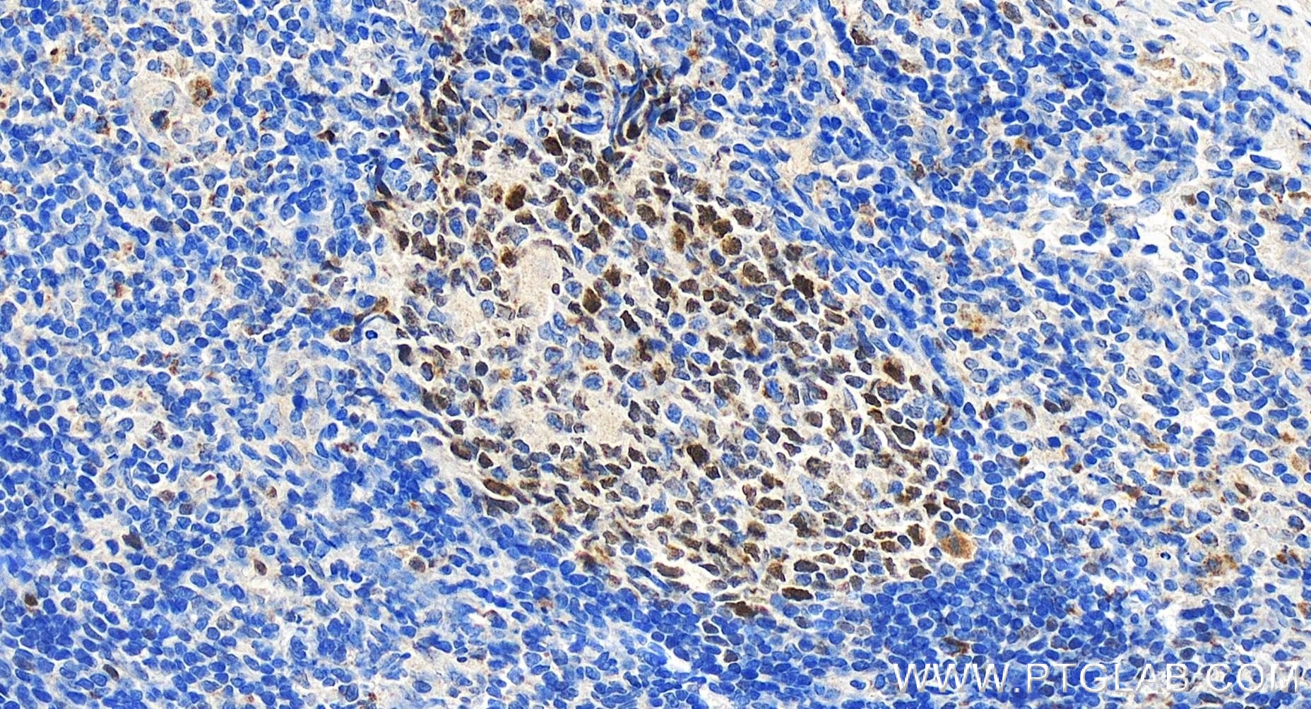 IHC staining of human tonsillitis using 81754-1-RR