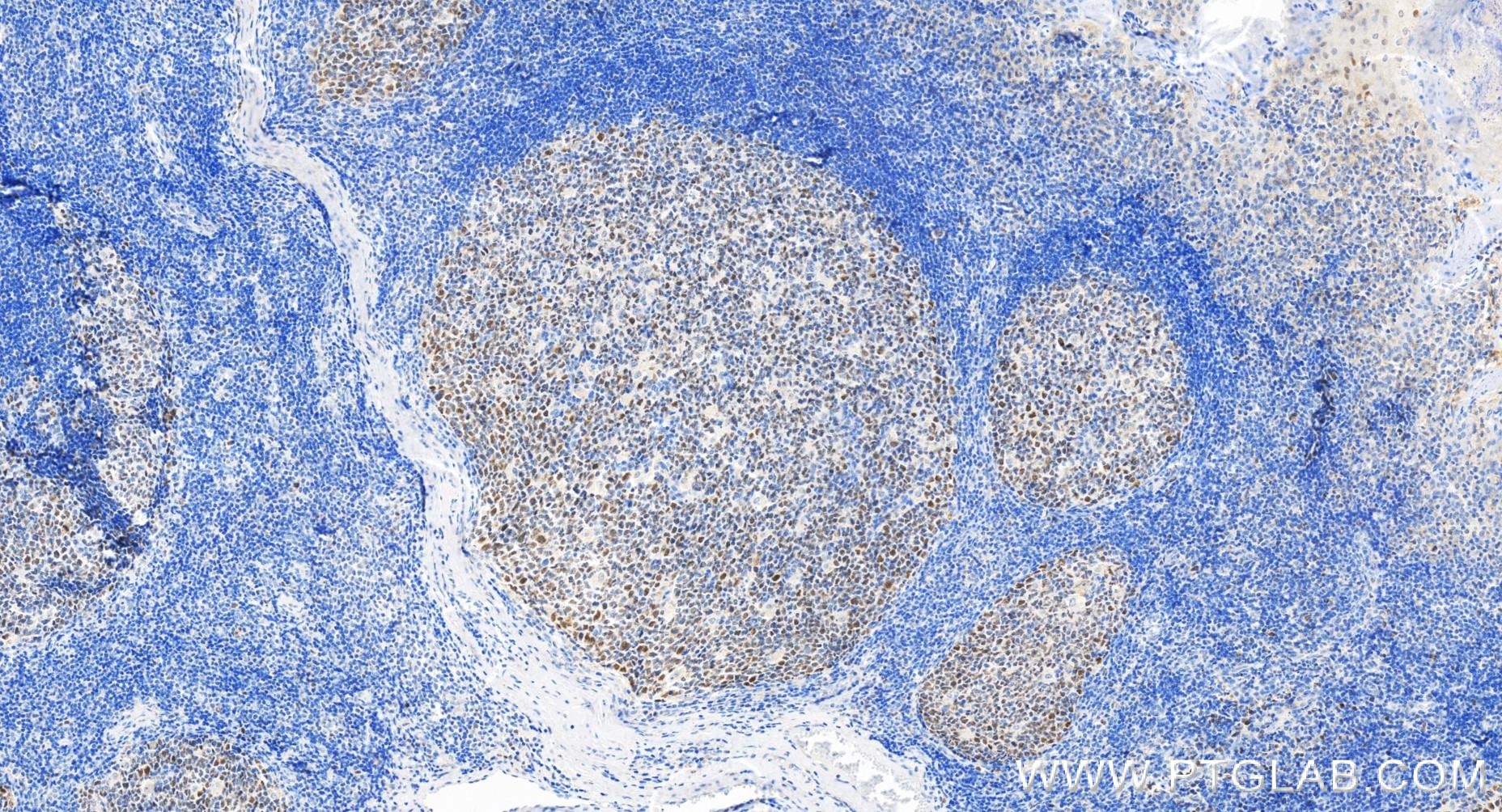 IHC staining of human tonsillitis using 81754-1-RR