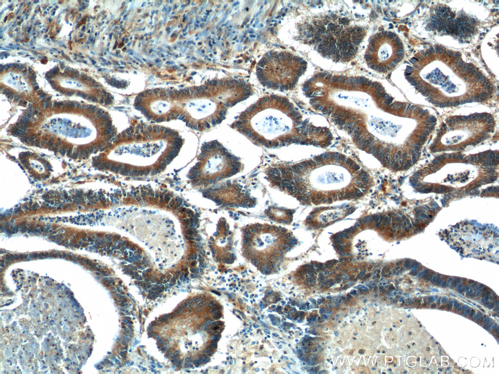 IHC staining of human colon cancer using 11740-1-AP