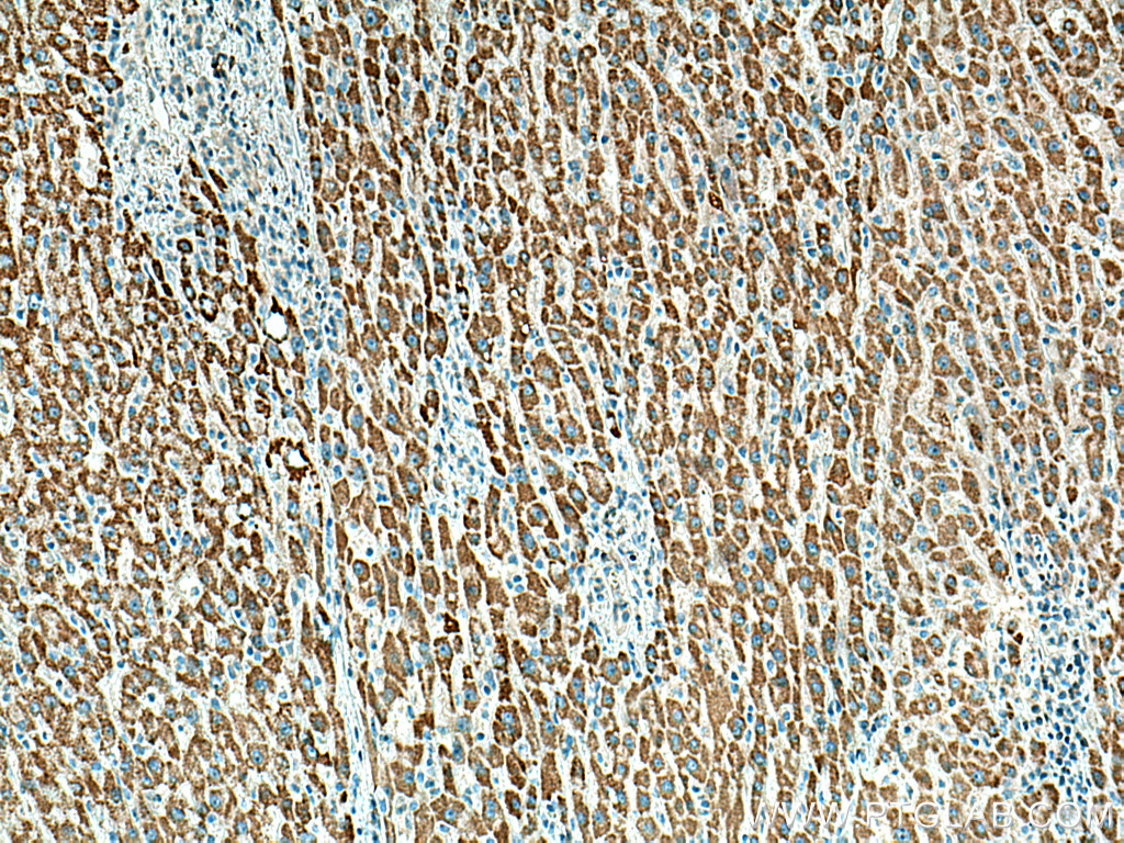 IHC staining of human liver cancer using 67448-1-Ig (same clone as 67448-1-PBS)