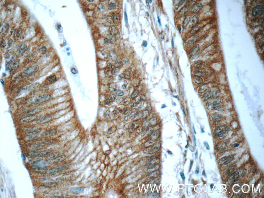 IHC staining of human colon cancer using 24711-1-AP