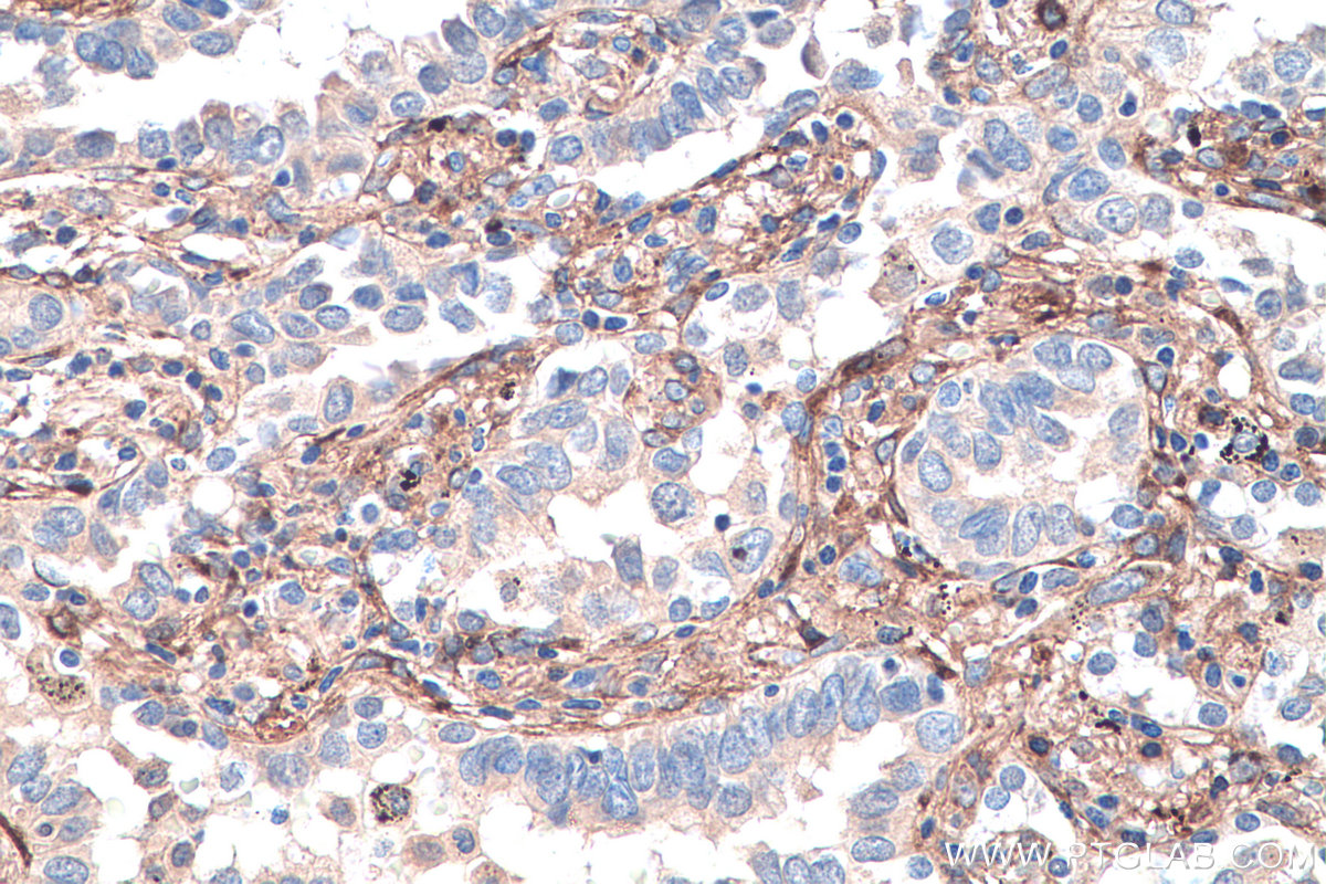 IHC staining of human lung cancer using 16409-1-AP