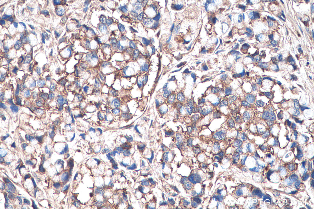 IHC staining of human colon cancer using 16409-1-AP