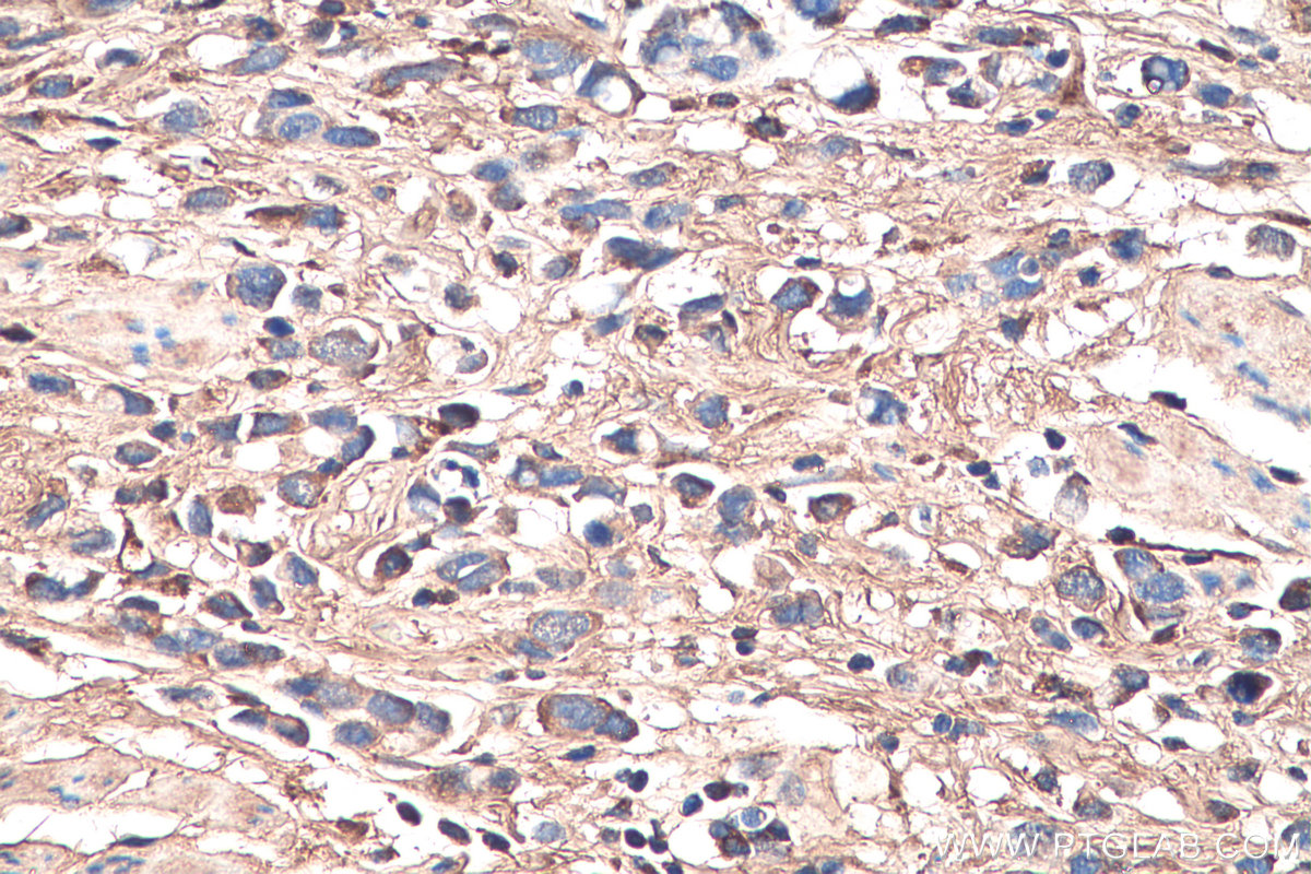 IHC staining of human stomach cancer using 16409-1-AP