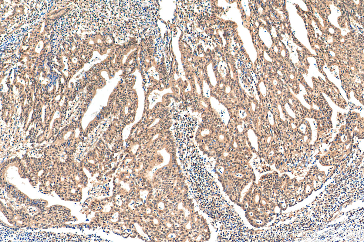 IHC staining of human endometrial cancer using 17895-1-AP (same clone as 17895-1-PBS)