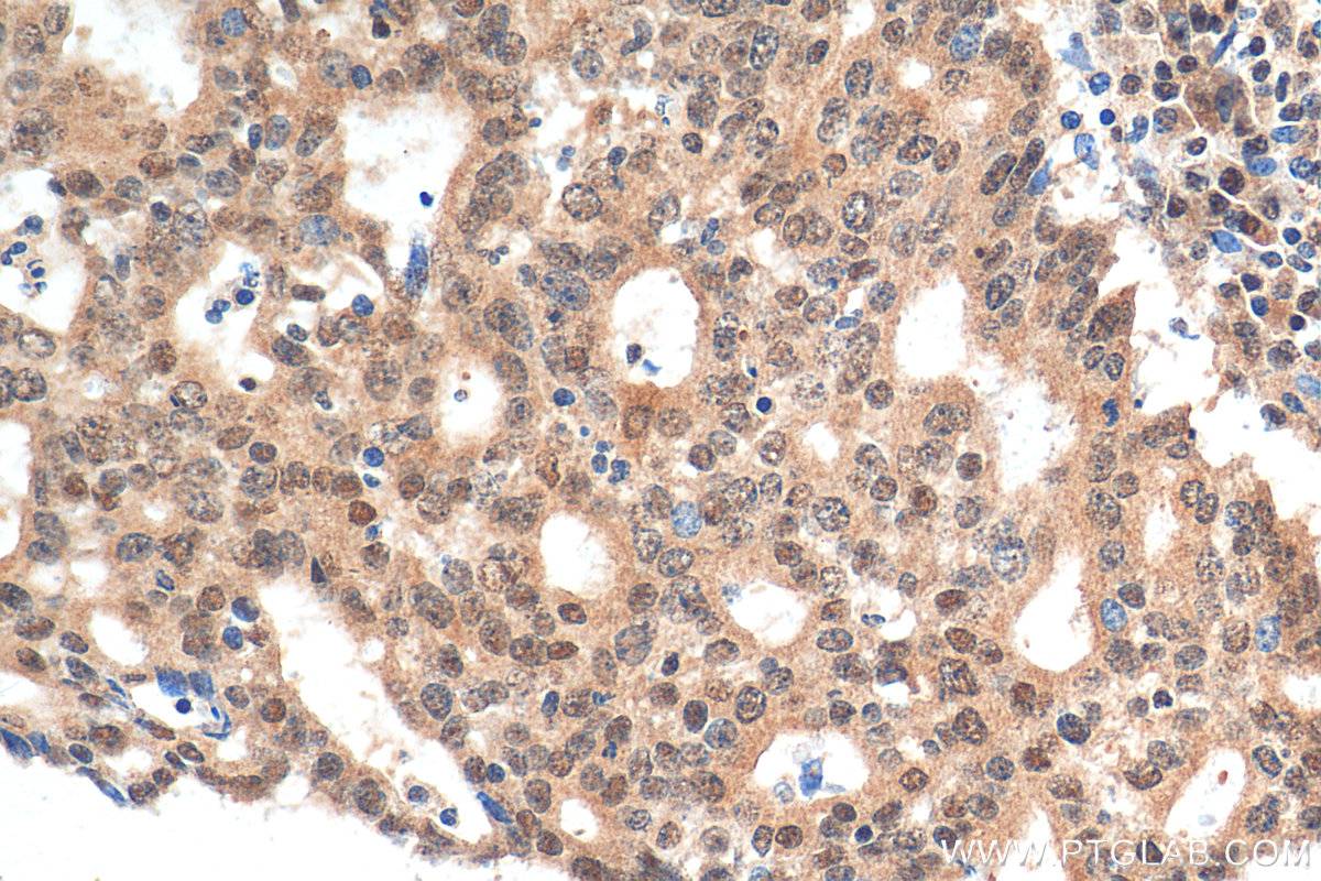 IHC staining of human endometrial cancer using 17895-1-AP (same clone as 17895-1-PBS)