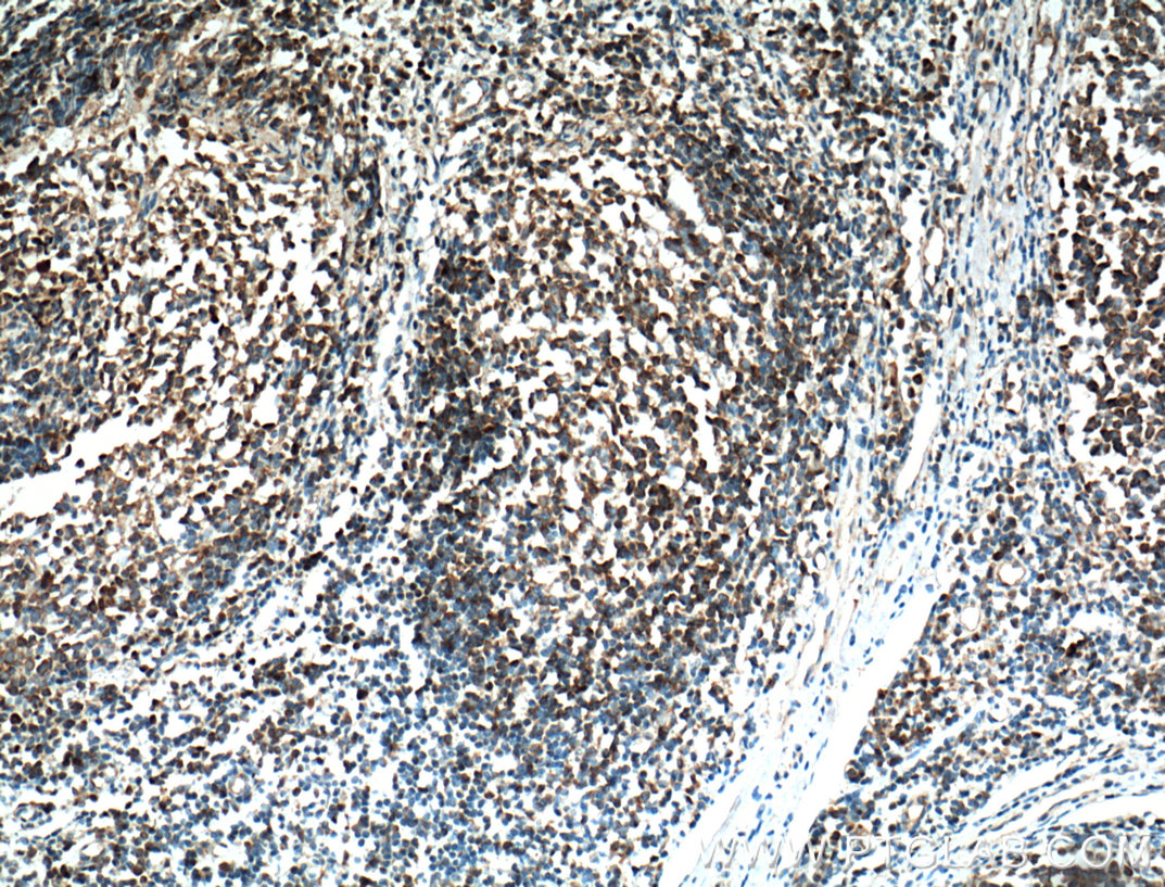 IHC staining of human tonsillitis using 10855-1-AP