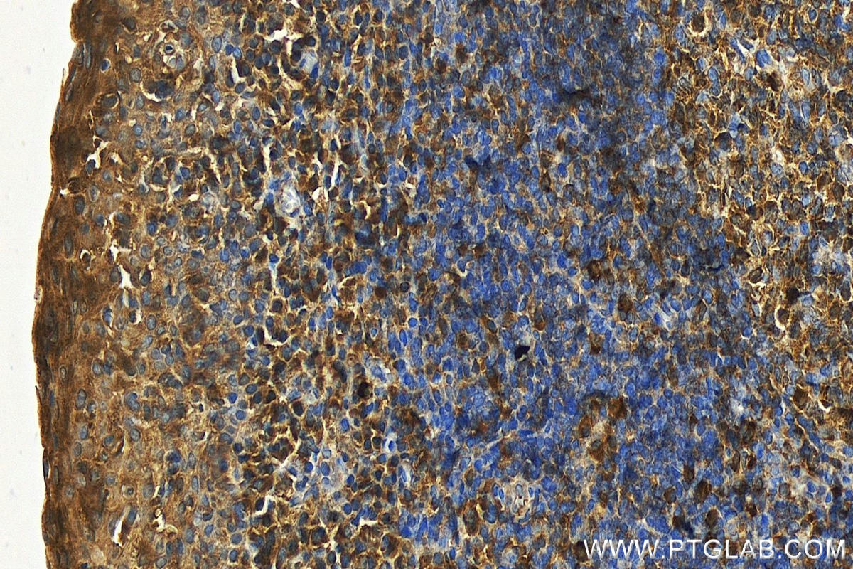 IHC staining of human tonsillitis using 10855-1-AP