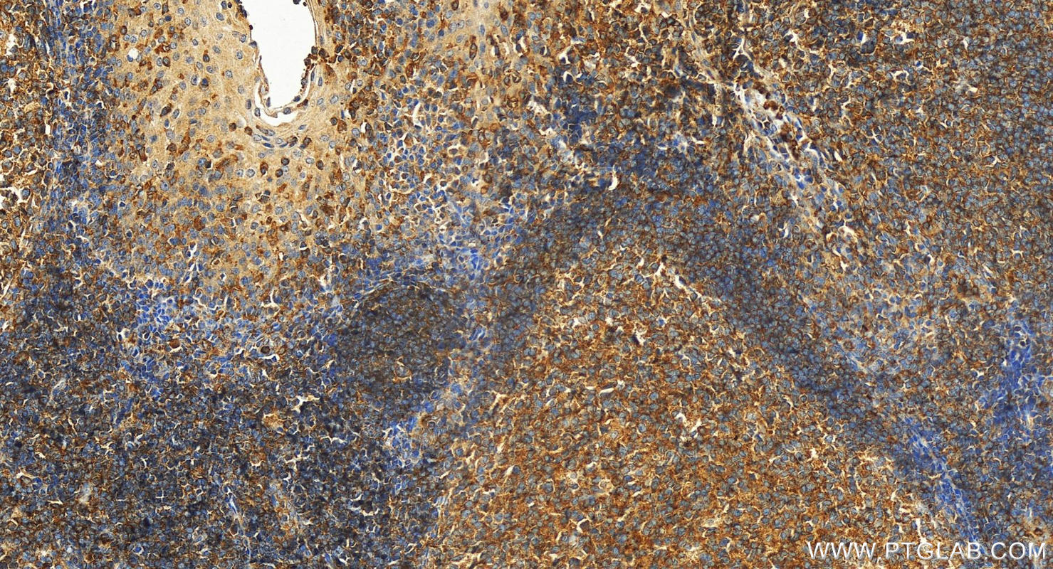 IHC staining of human tonsillitis using 55421-1-AP