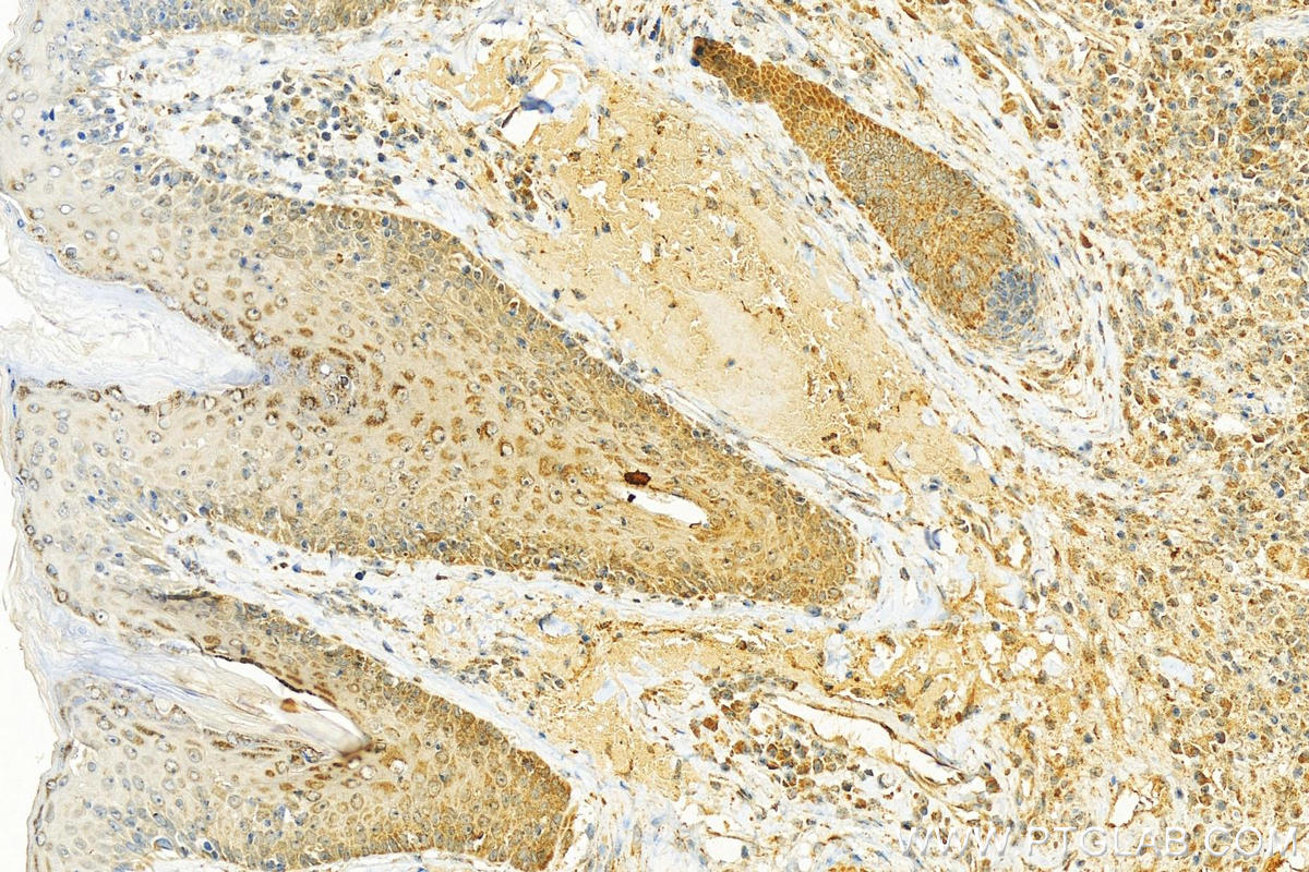 IHC staining of human skin cancer using 12986-1-AP