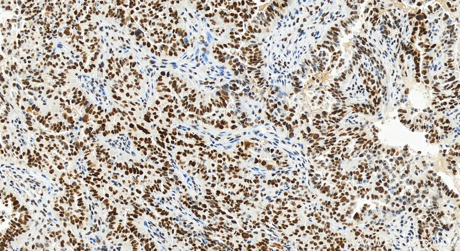 IHC staining of human ovarian  cancer using 82742-3-RR (same clone as 82742-3-PBS)