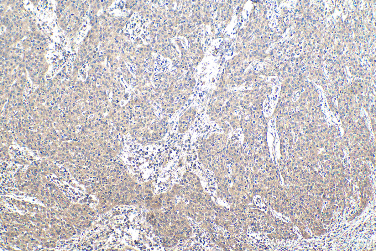 IHC staining of human cervical cancer using 11074-2-AP