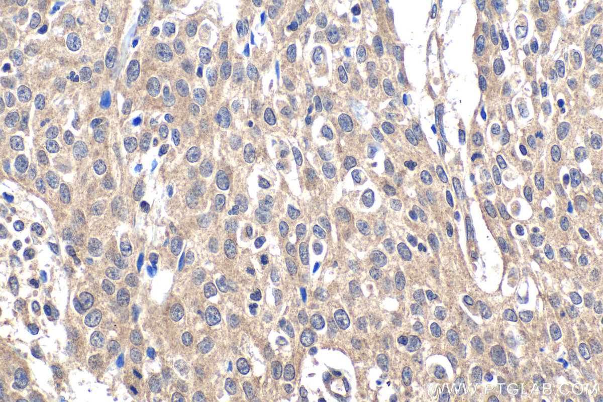 IHC staining of human cervical cancer using 11074-2-AP