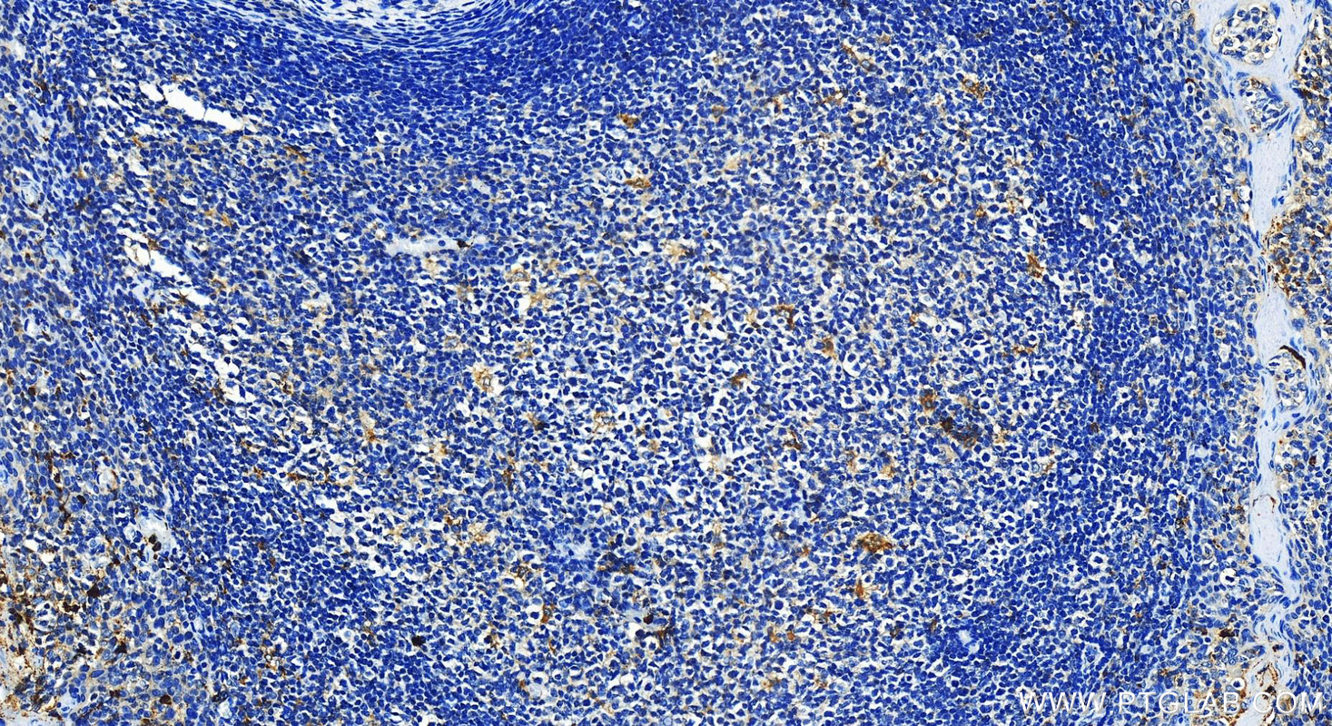 IHC staining of human tonsillitis using 14368-1-AP