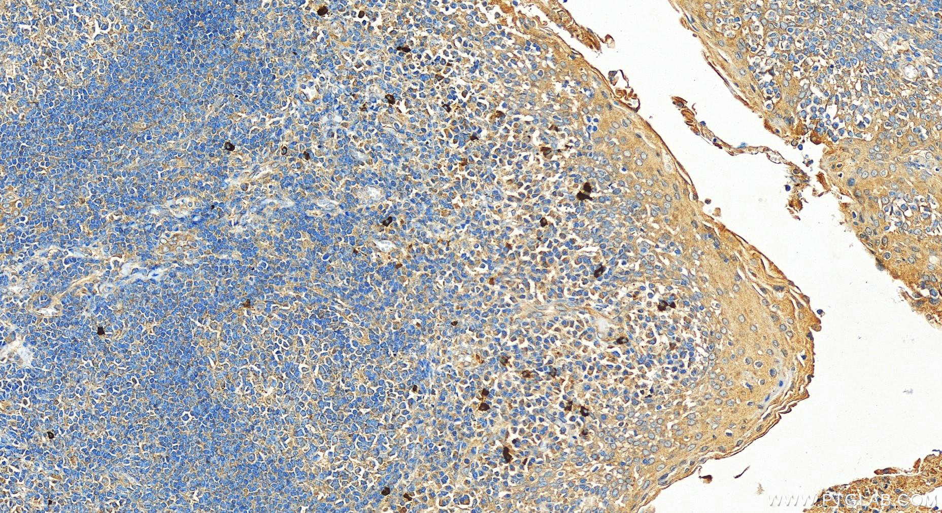 IHC staining of human tonsillitis using 13461-2-AP