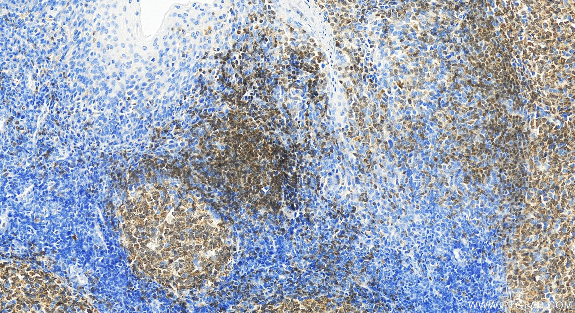 IHC staining of human tonsillitis using 26709-1-AP