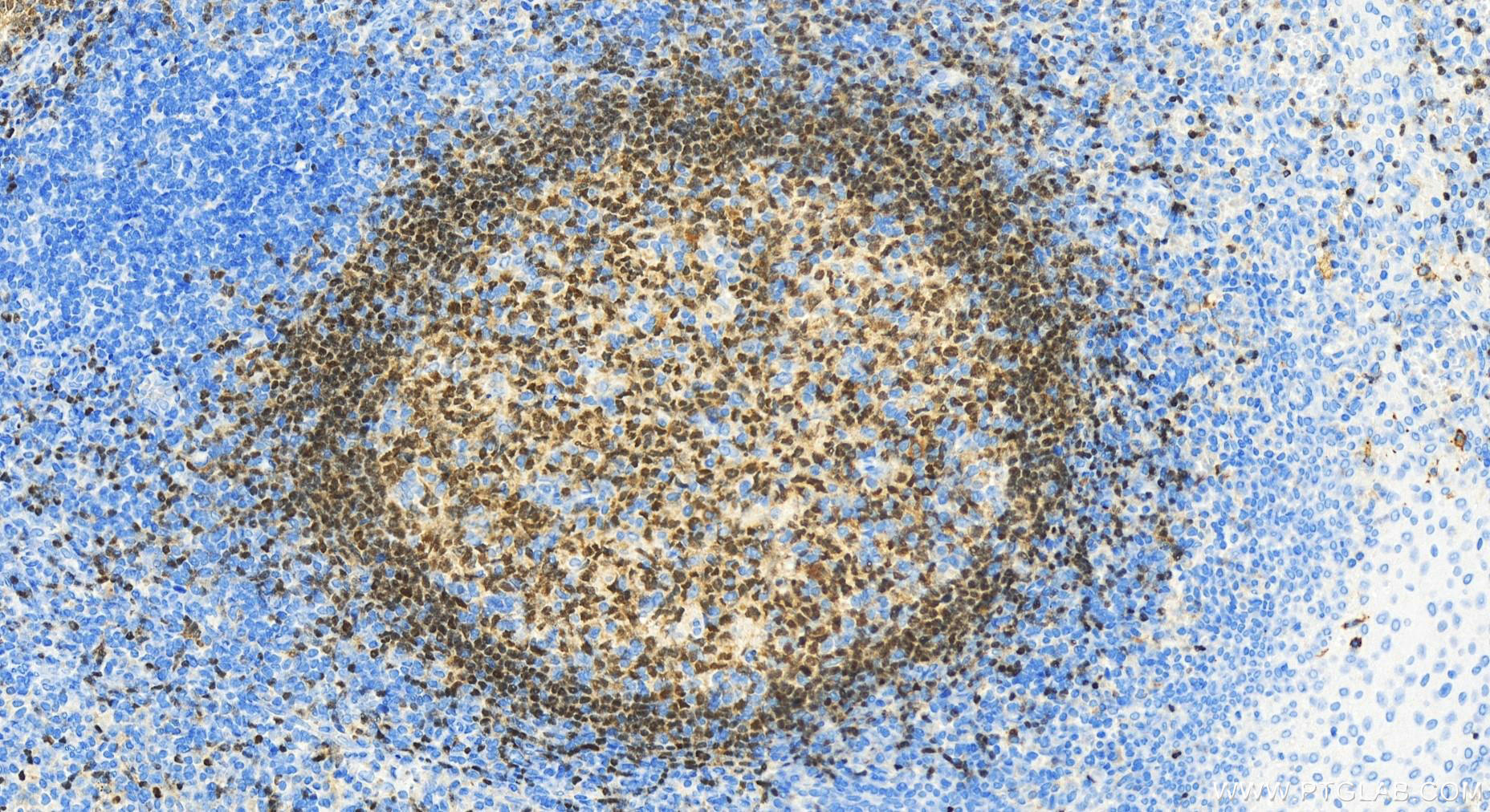 IHC staining of human tonsillitis using 26709-1-AP