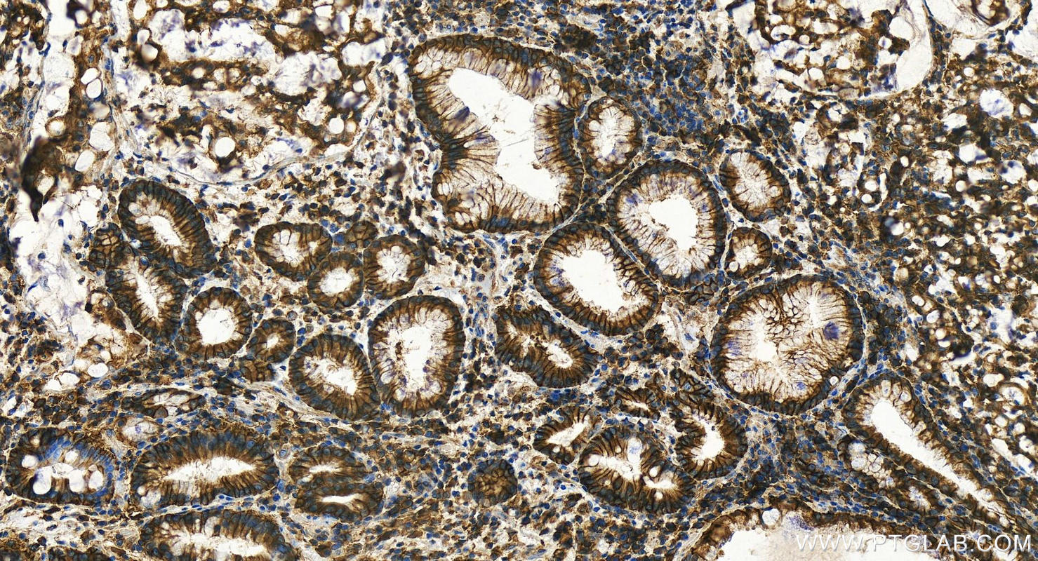 IHC staining of human stomach cancer using 11989-1-AP