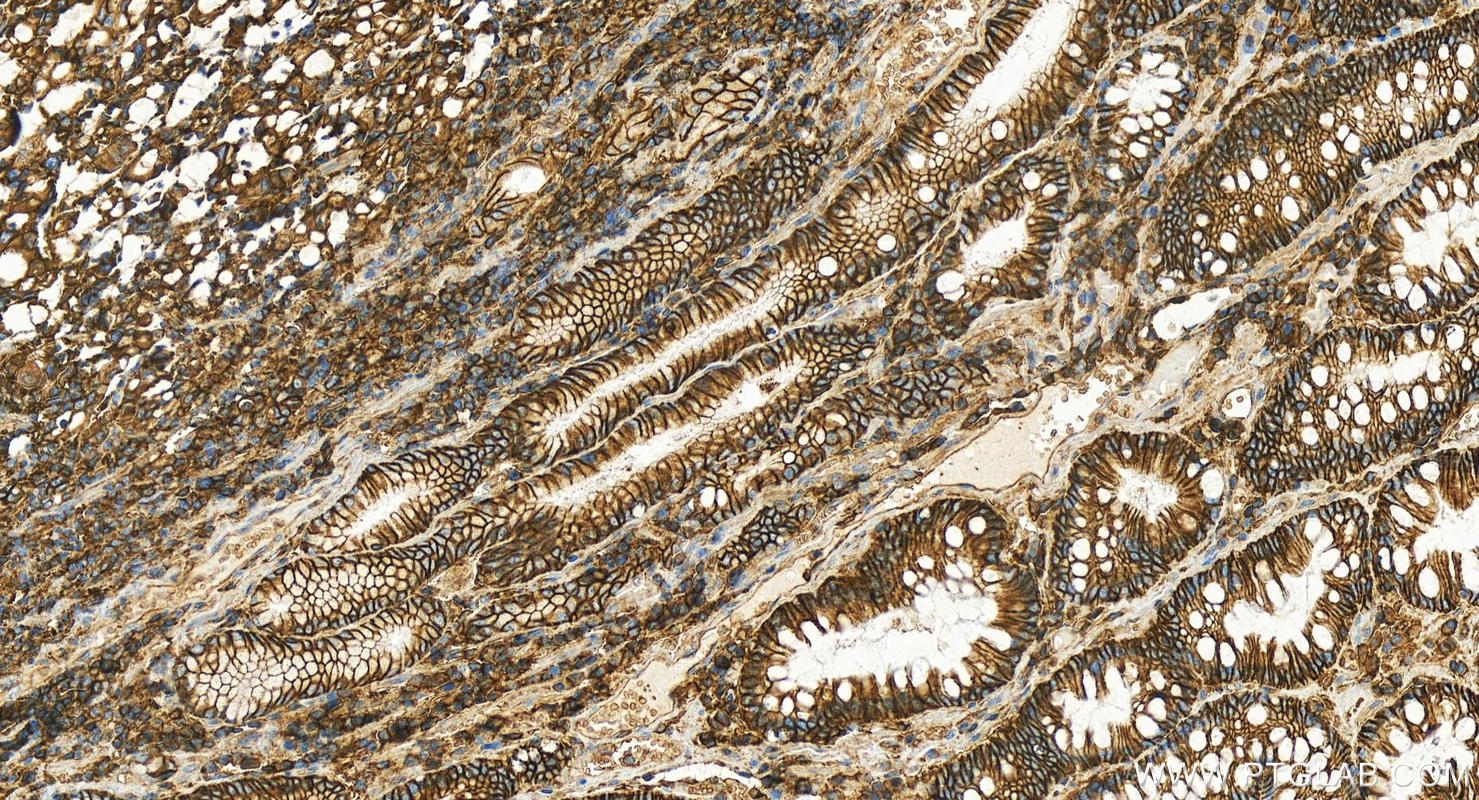 IHC staining of human stomach cancer using 11989-1-AP