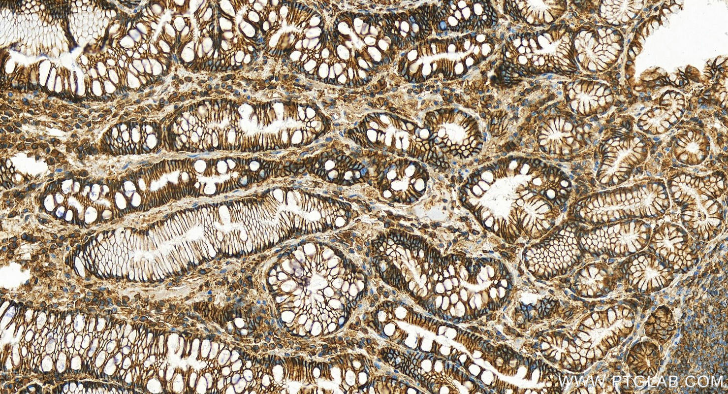 IHC staining of human stomach cancer using 11989-1-AP