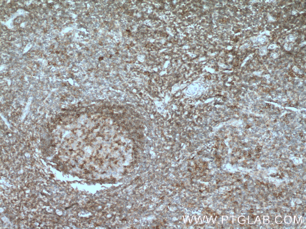 IHC staining of human tonsillitis using 21300-1-AP