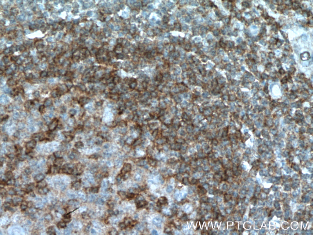 IHC staining of human tonsillitis using 21300-1-AP