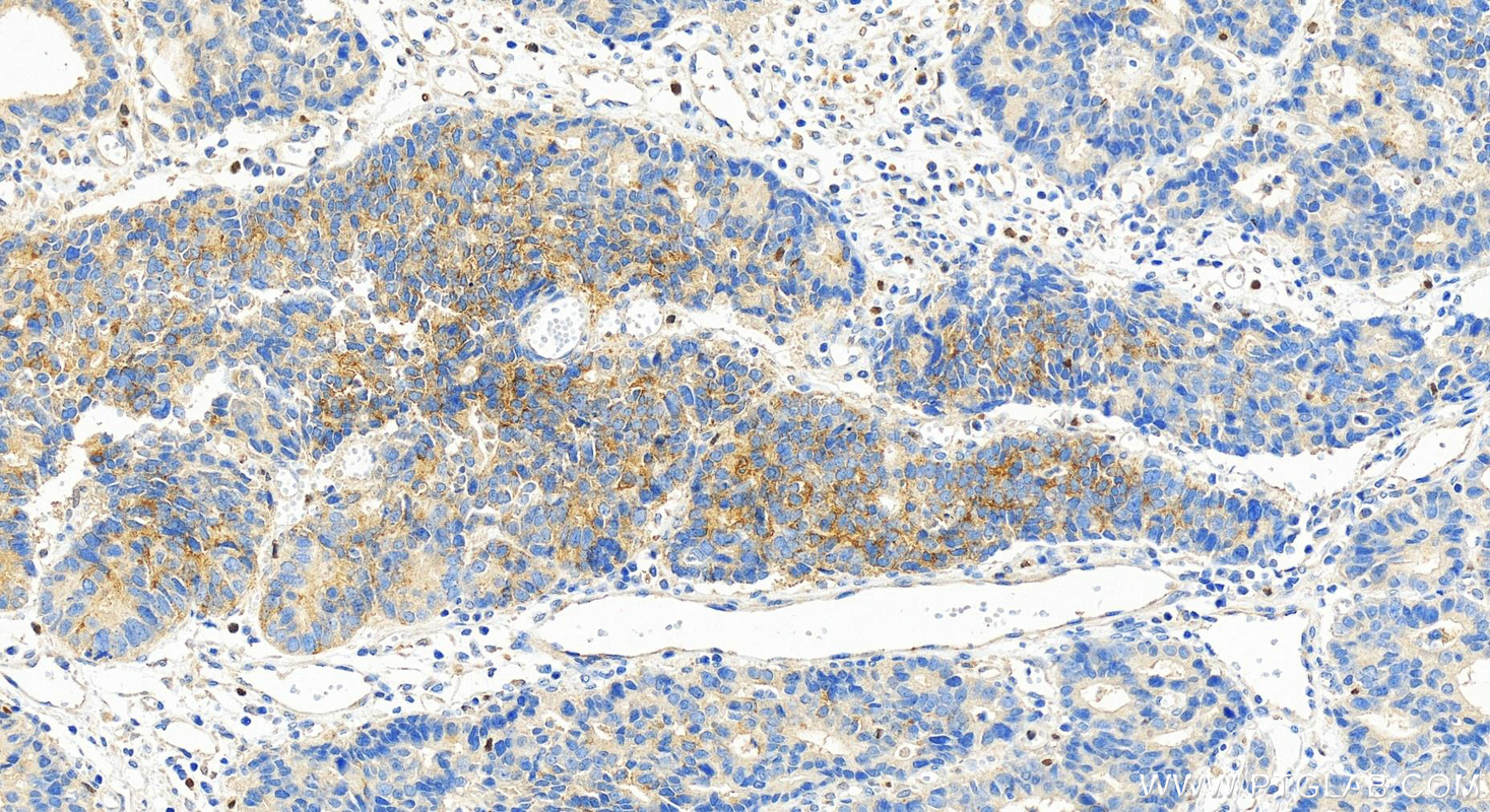 IHC staining of human stomach cancer using 24959-1-AP