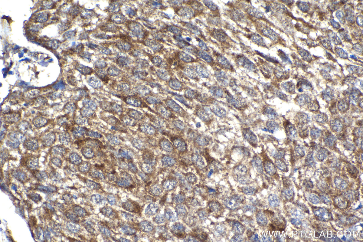 IHC staining of human cervical cancer using 11504-2-AP