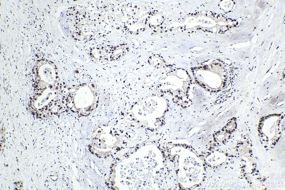 IHC staining of human pancreas cancer using 27073-1-AP