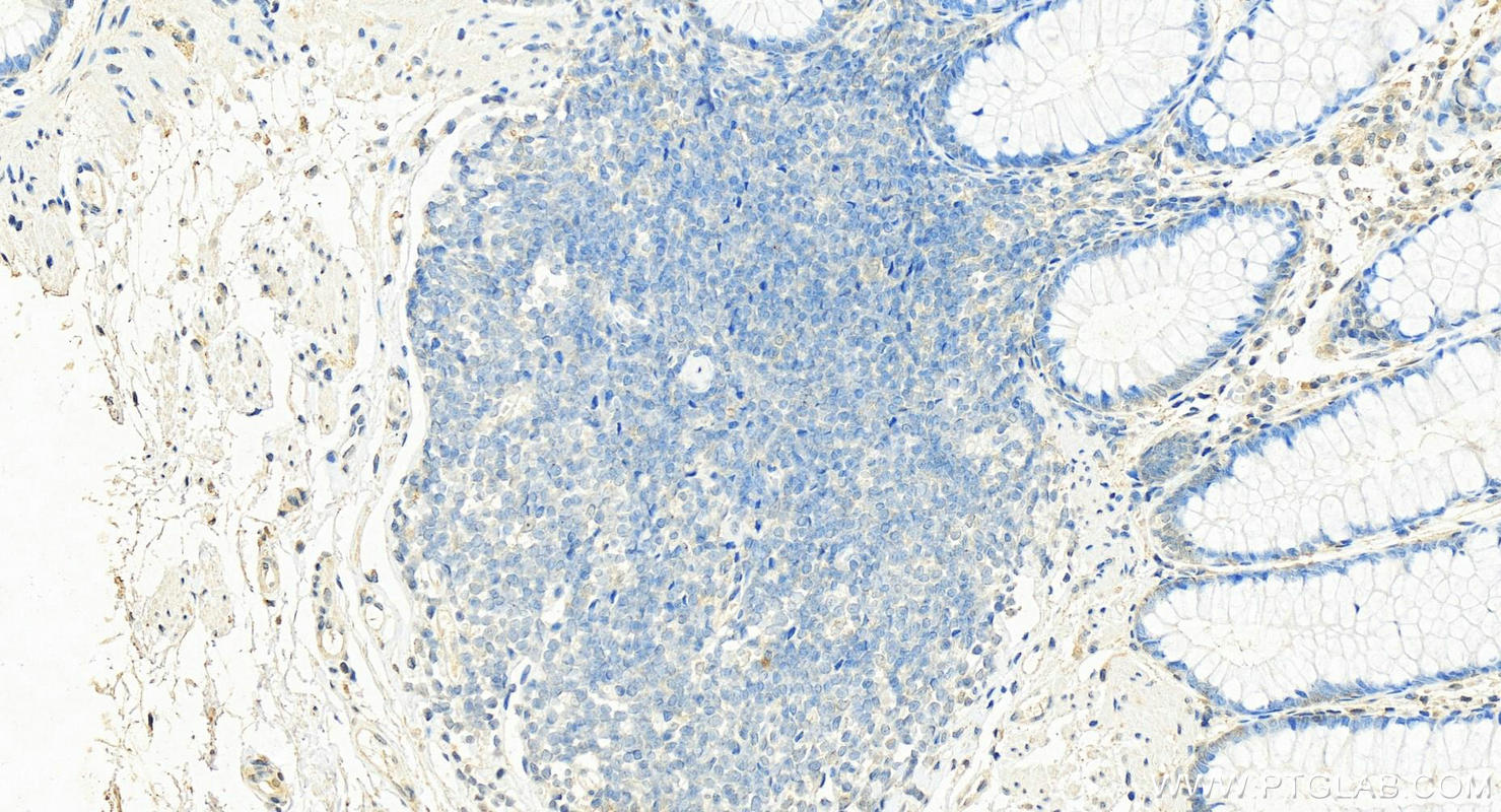 IHC staining of human colon using 68502-1-Ig (same clone as 68502-1-PBS)