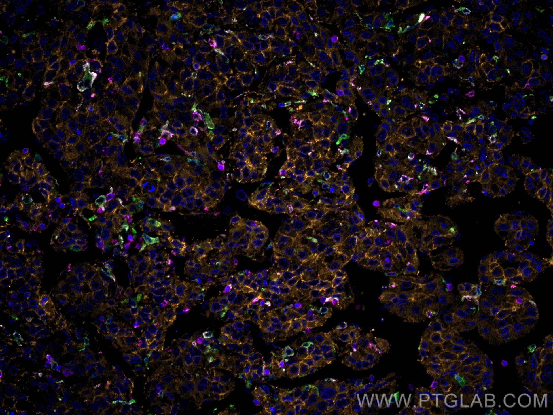 IF Staining of human liver cancer using CL555-51067