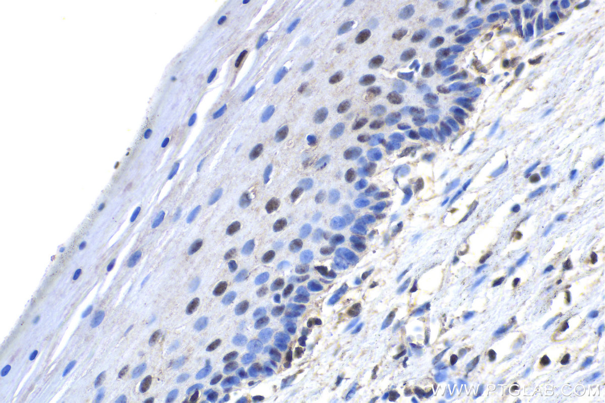 IHC staining of human cervical cancer using 21883-1-AP