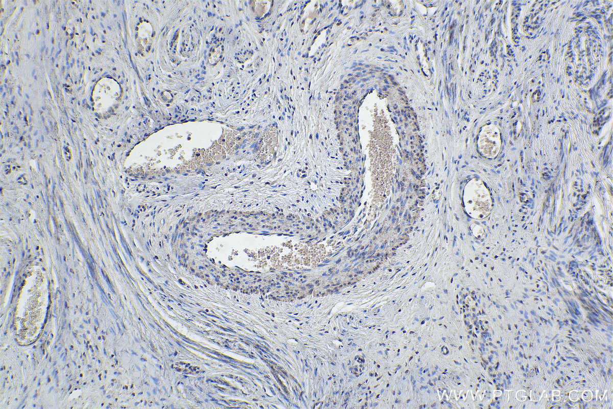 IHC staining of human cervical cancer using 21883-1-AP