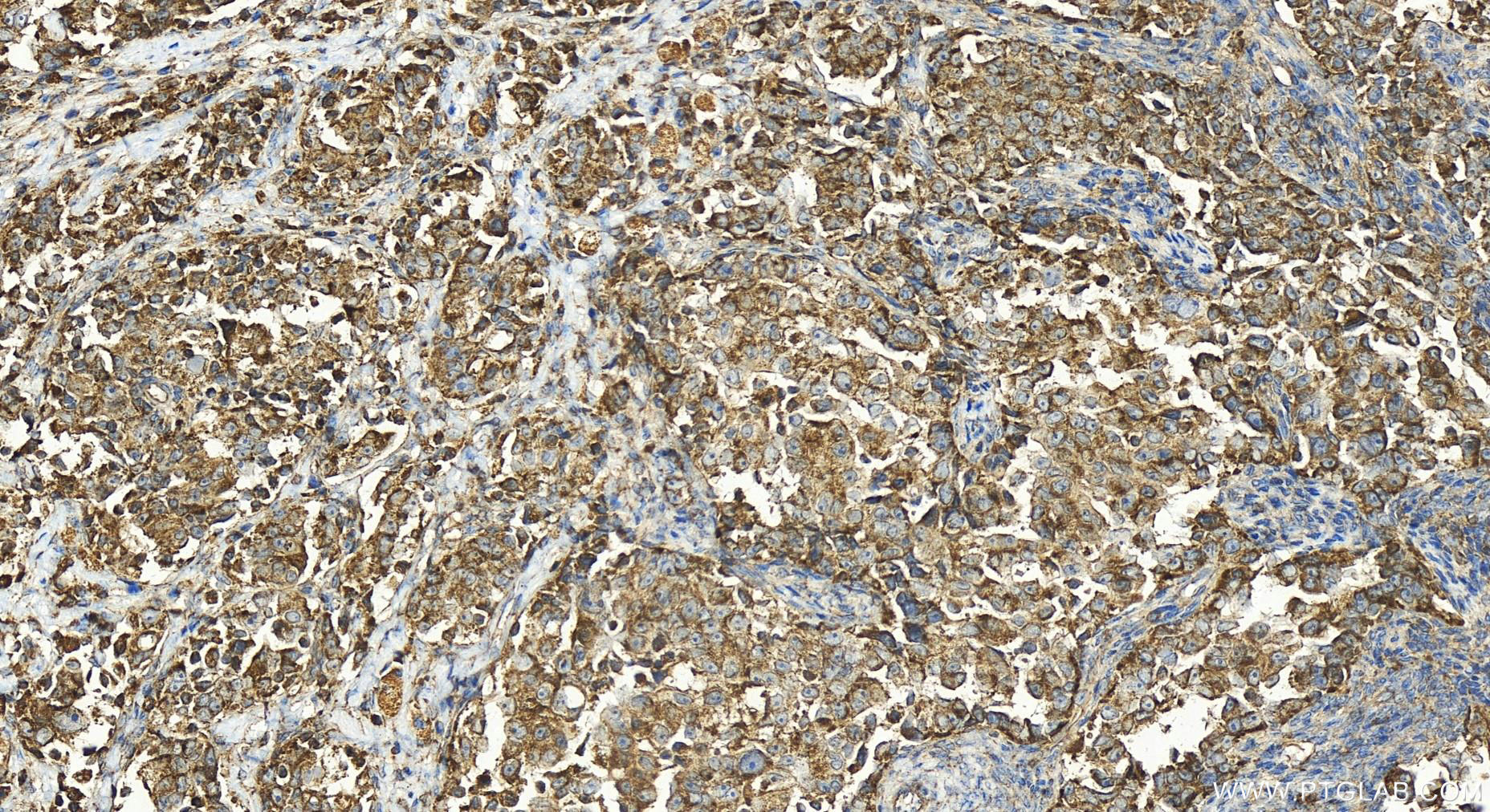 IHC staining of human ovary cancer using 26006-1-AP