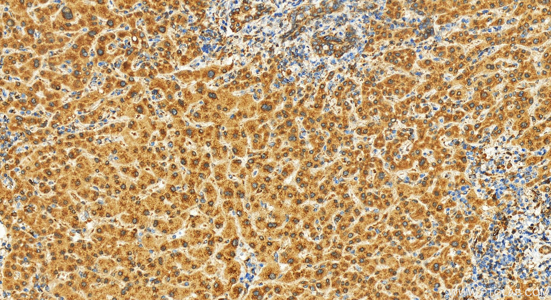 IHC staining of human intrahepatic cholangiocarcinoma using 27550-1-AP