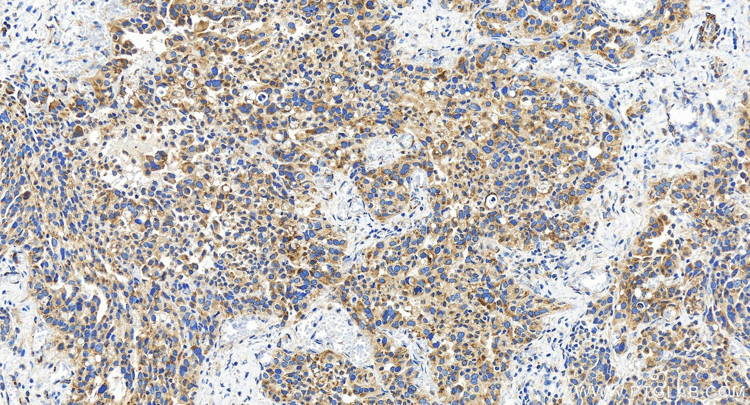 IHC staining of human ovary cancer using 27550-1-AP