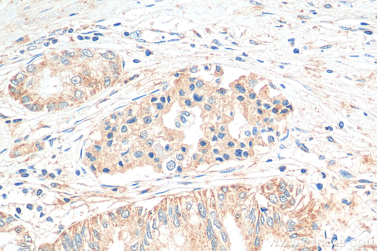 IHC staining of human pancreas cancer using 30246-1-AP