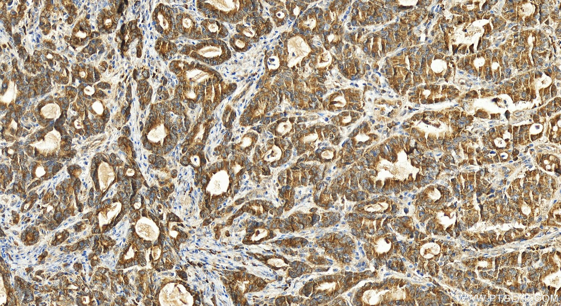 IHC staining of human stomach cancer using 21174-1-AP