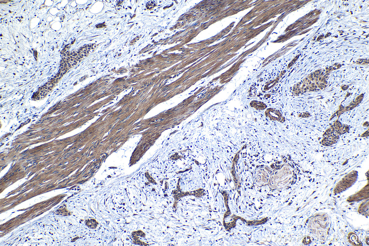 IHC staining of human urothelial carcinoma using 24977-1-AP