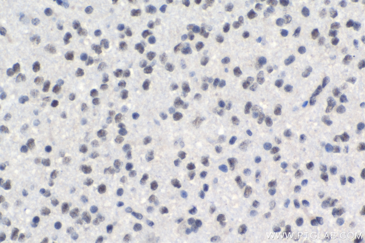 IHC staining of human gliomas using 19420-1-AP