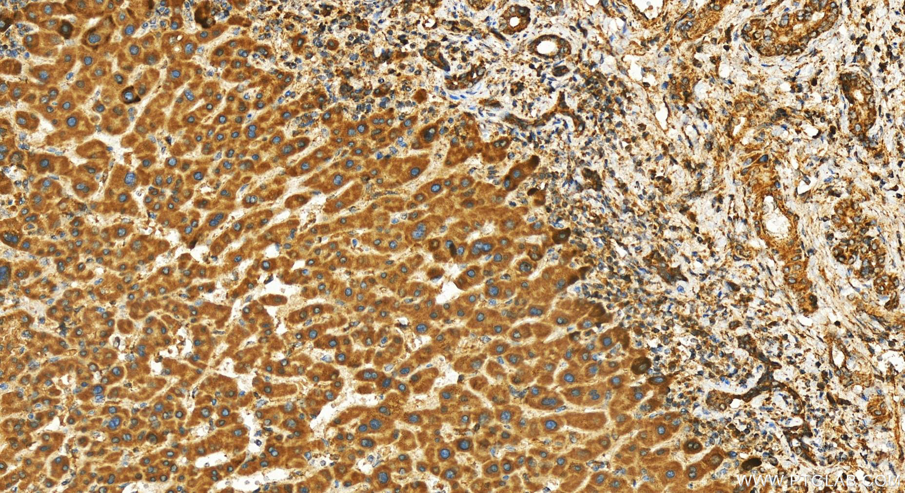 IHC staining of human intrahepatic cholangiocarcinoma using 25652-1-AP