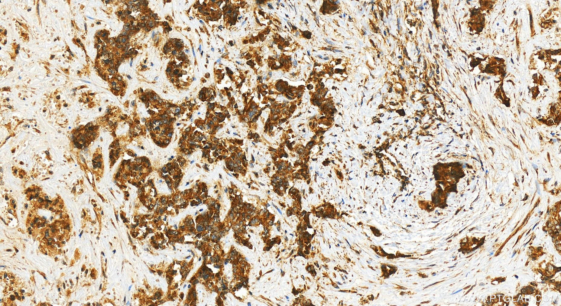 IHC staining of human intrahepatic cholangiocarcinoma using 25652-1-AP