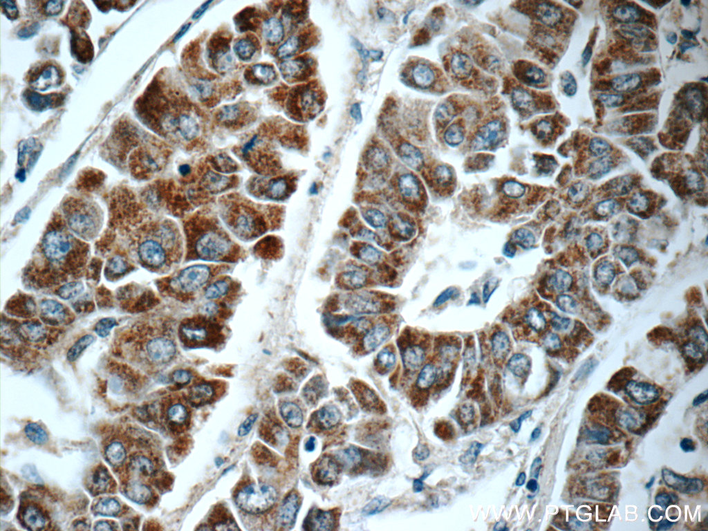 IHC staining of human liver cancer using 25433-1-AP