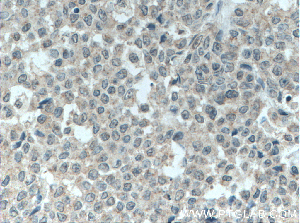 IHC staining of human colon cancer using 19912-1-AP