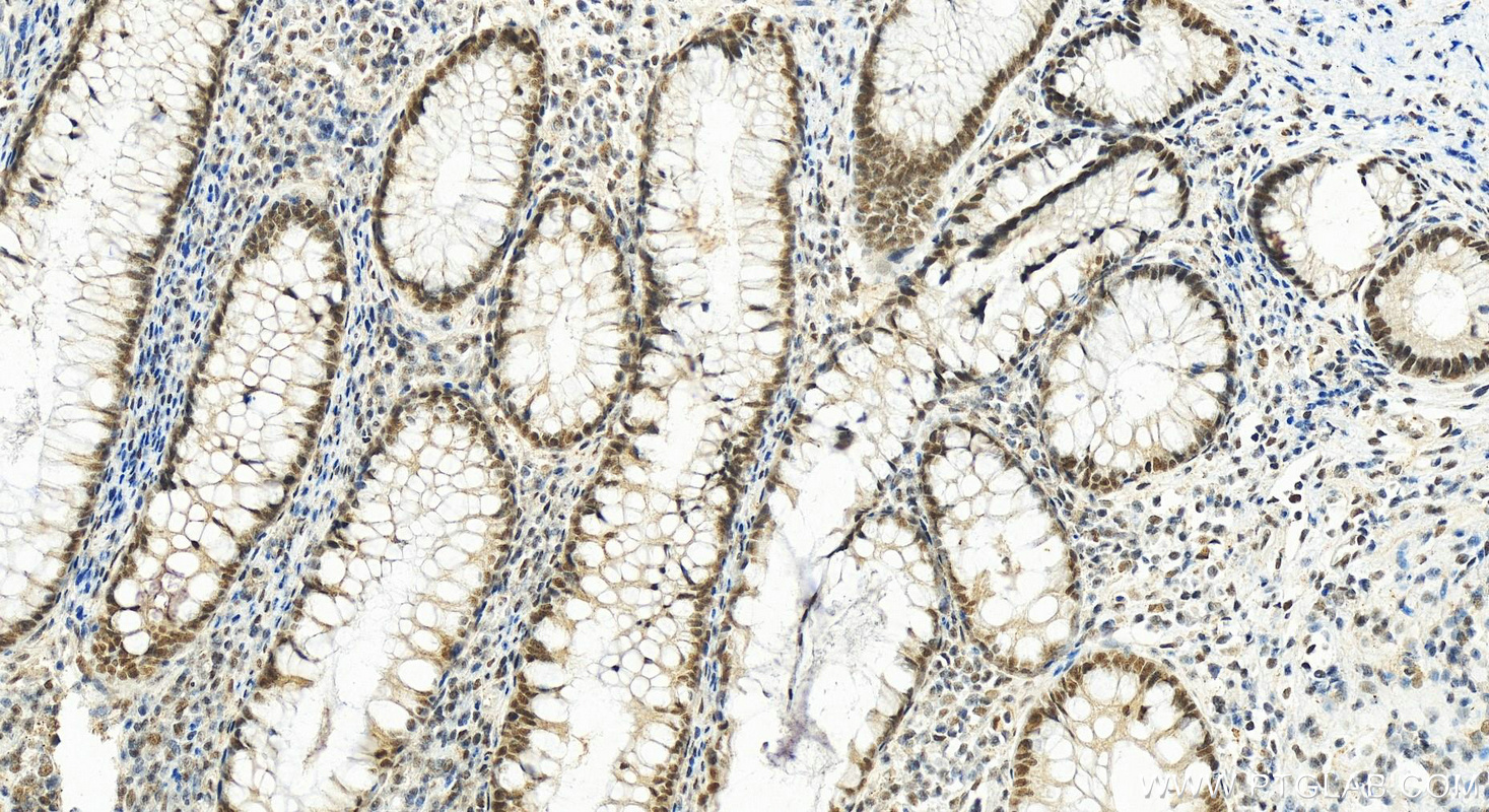 IHC staining of human colon cancer using 26040-1-AP