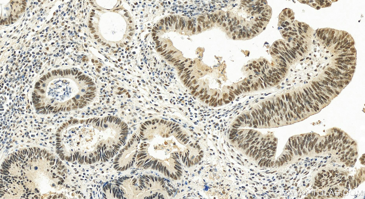 IHC staining of human colon cancer using 26040-1-AP