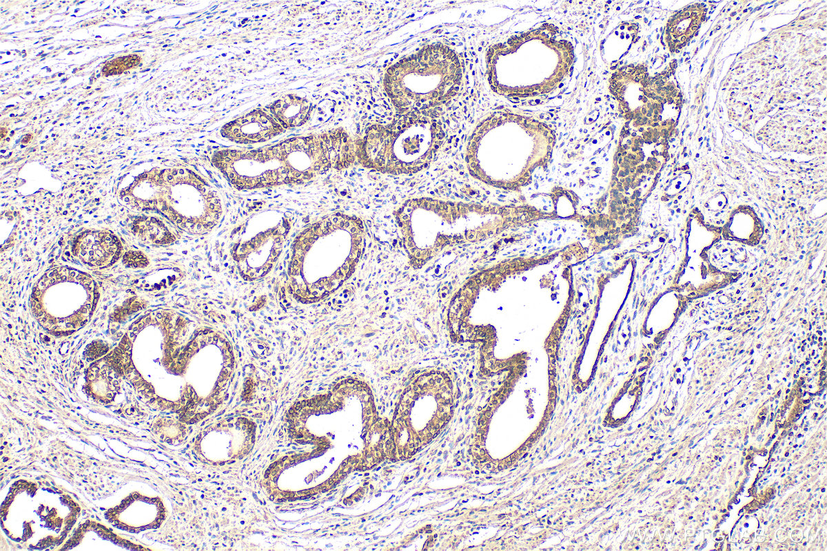 IHC staining of human prostate cancer using 67464-1-Ig (same clone as 67464-1-PBS)