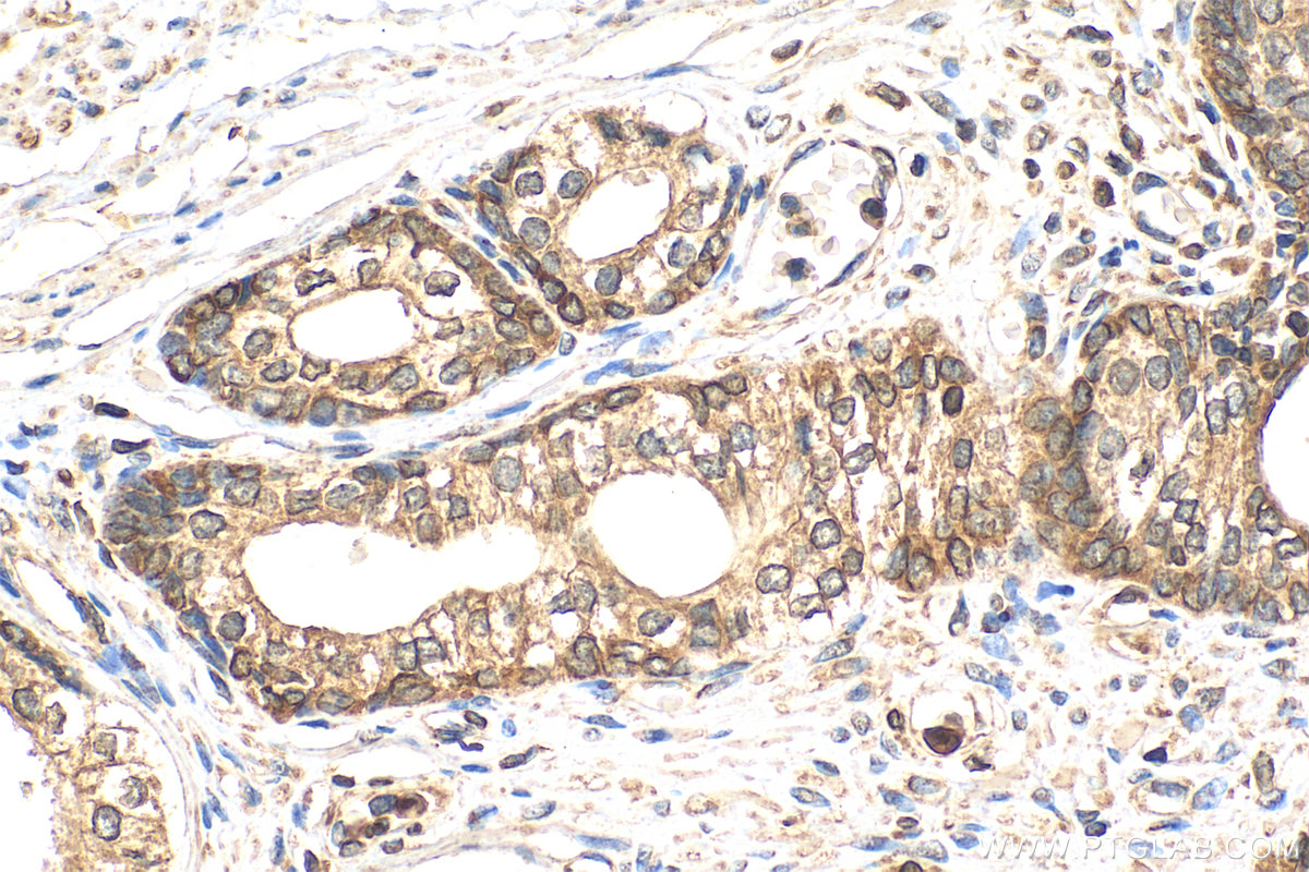 IHC staining of human prostate cancer using 67464-1-Ig (same clone as 67464-1-PBS)