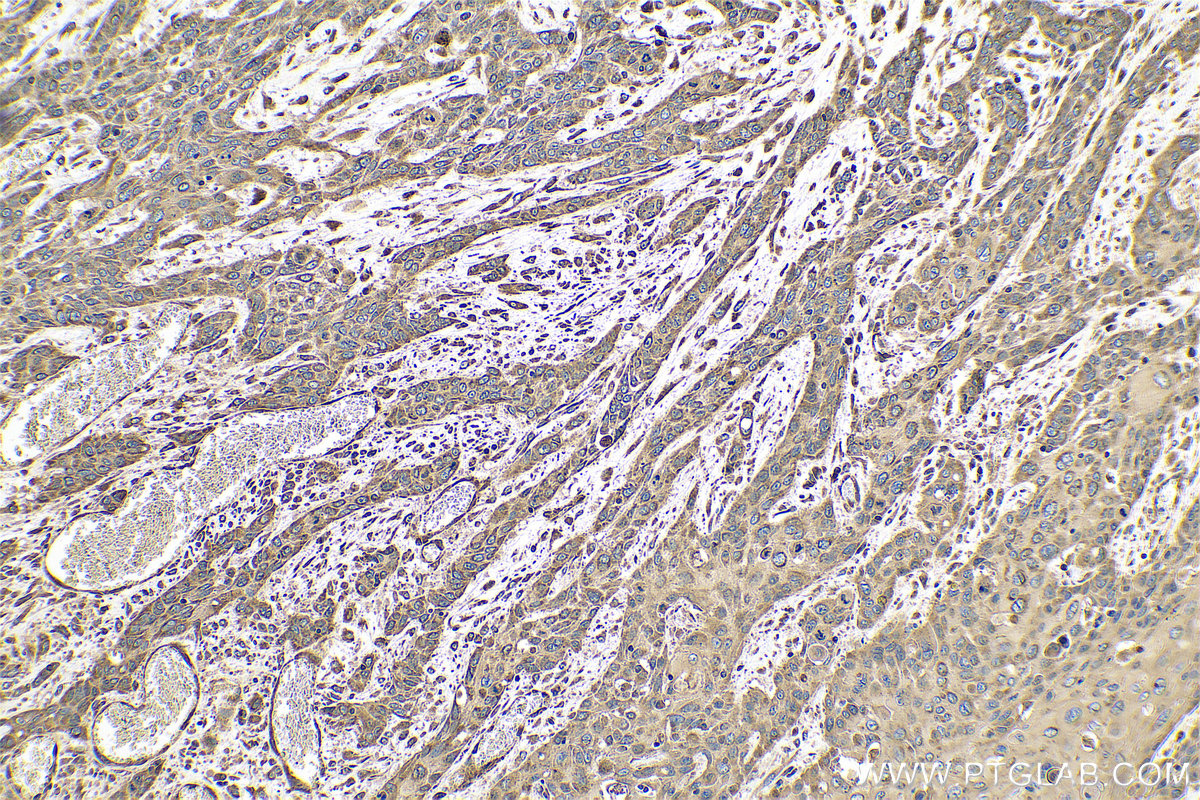 IHC staining of human oesophagus cancer using 25626-1-AP