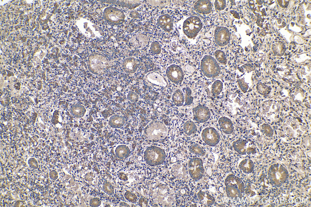 IHC staining of human stomach cancer using 25626-1-AP